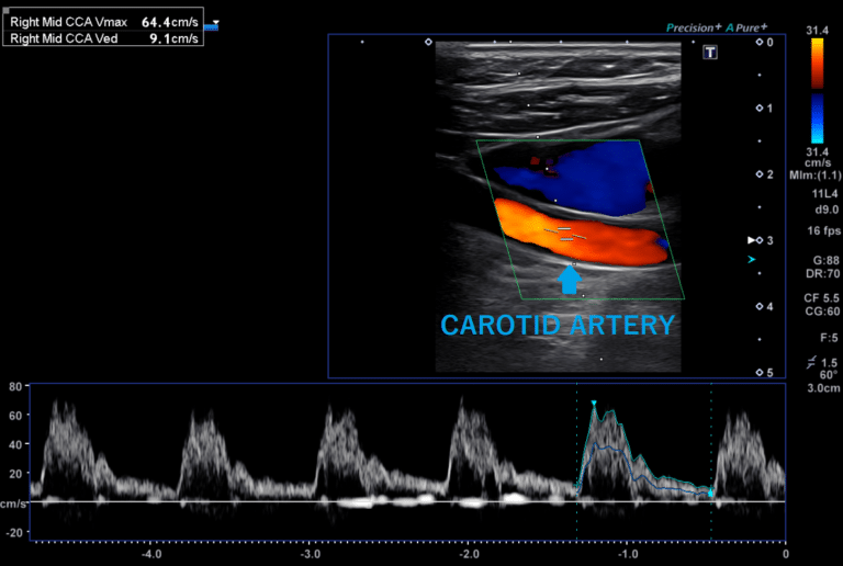 carotid