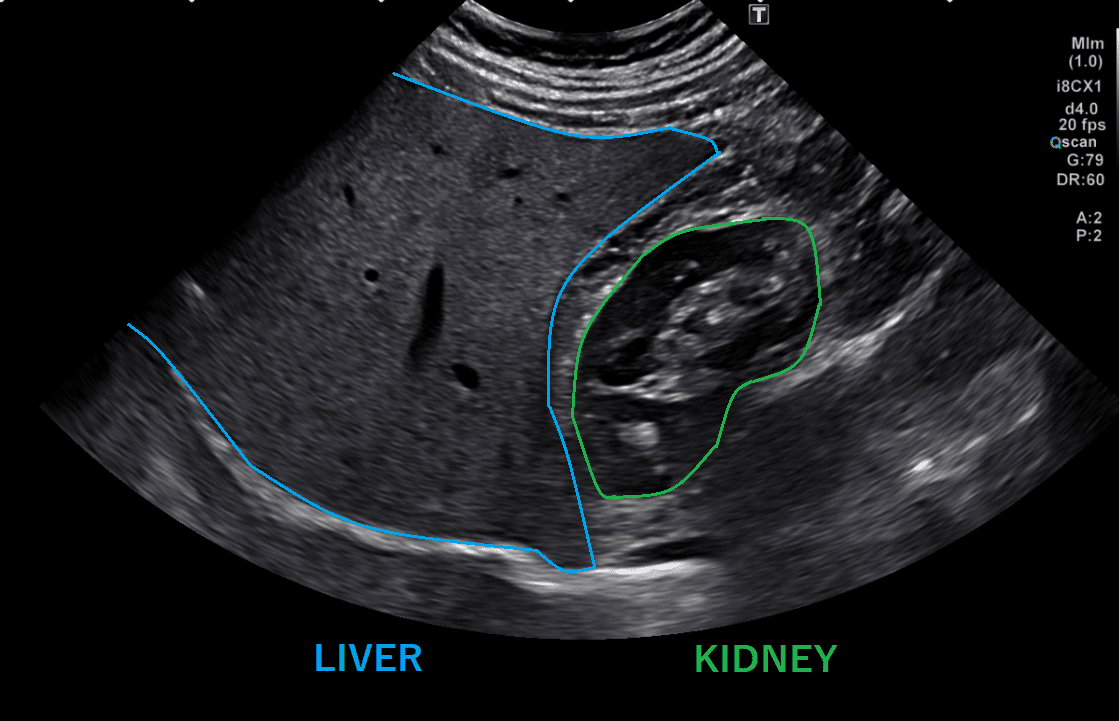 liver rt kidney