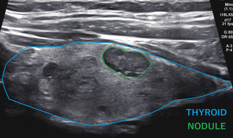 thyroid long nodule